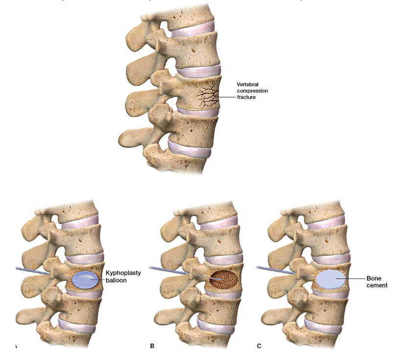 spine fracture